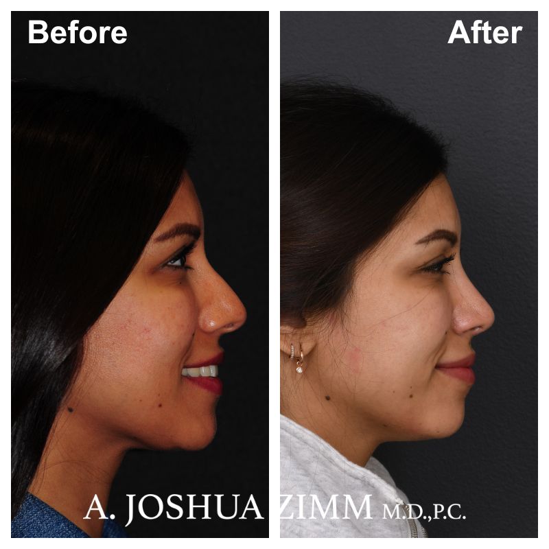 Rhinoplasty - before and after