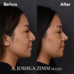 Rhinoplasty - before and after