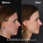 Rhinoplasty - before and after