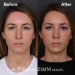 Rhinoplasty - before and after