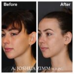 Rhinoplasty - before and after