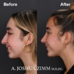 Rhinoplasty - before and after