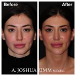 Chin implant - before and after