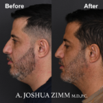 Chin implant - before and after