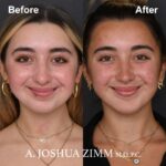 Chin implant - before and after