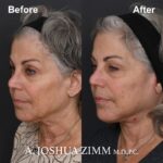 Facelift - before and after