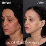 Facelift - before and after