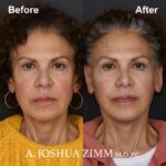 Facelift - before and after