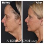 Facelift - before and after