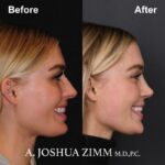 Rhinoplasty - before and after