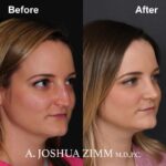 Rhinoplasty - before and after