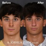 Rhinoplasty - before and after