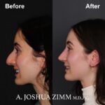 Rhinoplasty - before and after