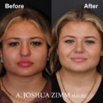 Rhinoplasty - before and after