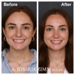 Rhinoplasty - before and after