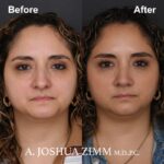 Rhinoplasty - before and after