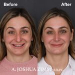 Rhinoplasty - before and after