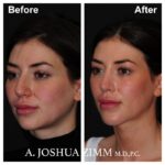 Rhinoplasty - before and after