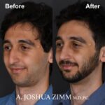 Rhinoplasty - before and after