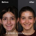 Rhinoplasty - before and after