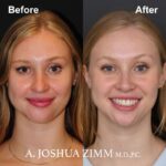 Rhinoplasty - before and after