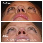 Rhinoplasty - before and after