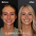 Rhinoplasty - before and after