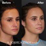 Rhinoplasty - before and after