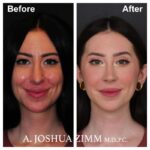 Rhinoplasty - before and after