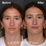 Rhinoplasty - before and after