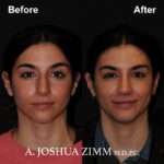 Rhinoplasty - before and after