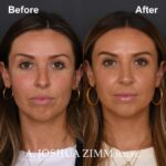 Rhinoplasty - before and after