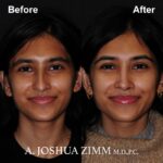 Rhinoplasty - before and after