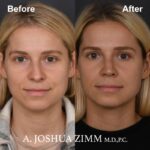 Rhinoplasty - before and after