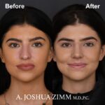 Rhinoplasty - before and after