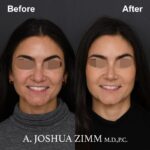 Rhinoplasty - before and after