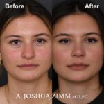 Rhinoplasty - before and after