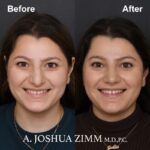 Rhinoplasty - before and after