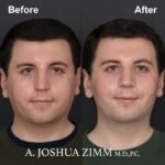 Rhinoplasty - before and after