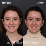 Rhinoplasty - before and after