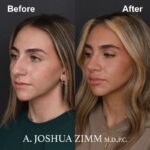 Rhinoplasty - before and after