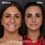 Rhinoplasty - before and after