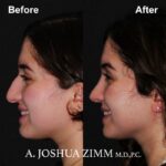 Rhinoplasty - before and after