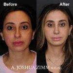 Rhinoplasty - before and after