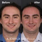 Rhinoplasty - before and after