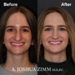 Rhinoplasty - before and after