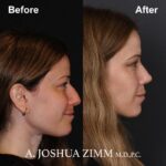 Rhinoplasty - before and after