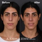 Rhinoplasty - before and after