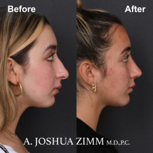 Rhinoplasty - before and after