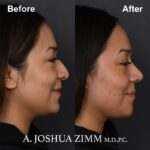 Rhinoplasty - before and after